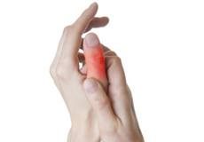 Finger Sprain