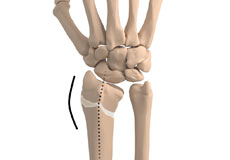 Malunion of a Fracture