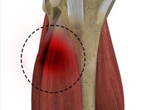 Muscle Sparing Total Knee Replacement