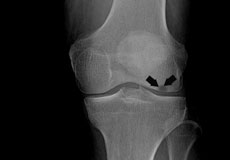 Osteonecrosis of the Knee