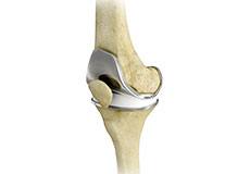 Short-Stay and Fast-Track Knee Replacement
