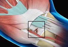 Wrist Ligament Tear and Instability